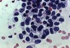 Cervical Cancer, CIN3+ Screening After 5 Years in HPV-Negative Women Cervical Cancer, CIN3+ Screening After 5 Years in HPV-Negative Women