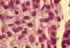 Less Frequent Cervical Cancer Screening May Be Okay After HPV Vaccine Less Frequent Cervical Cancer Screening May Be Okay After HPV Vaccine