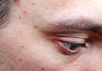 <i>Propionibacterium acnes</i> Triggers Inflammation, Acne <i>Propionibacterium acnes</i> Triggers Inflammation, Acne