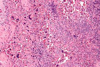 Histomorphologic changes in a lymph node due to systemic lupus erythematosus. <i>Photo Credit: By Nephron (Own work), via Wikimedia Commons.</i> Histomorphologic changes in a lymph node due to systemic lupus erythematosus. <i>Photo Credit: By Nephron (Own work), via Wikimedia Commons.</i>