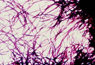 An impression smear photomicrograph of <i>C difficile</i> bacteria grown on cycloserine mannitol blood agar. <i>Photo Credit: CDC/ Dr. Gilda Jones.</i> An impression smear photomicrograph of <i>C difficile</i> bacteria grown on cycloserine mannitol blood agar. <i>Photo Credit: CDC/ Dr. Gilda Jones.</i>