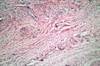 Elevated Risk of HPV Infection in Women With SLE Elevated Risk of HPV Infection in Women With SLE