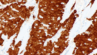 Rates of distant metastases were increased for active smokers and those with T4 tumors. <i>Photo Credit by Nephron, via Wikimedia Commons.</i> Rates of distant metastases were increased for active smokers and those with T4 tumors. <i>Photo Credit by Nephron, via Wikimedia Commons.</i>