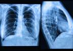 New Antibiotic Therapy Improves Acute Lung Function in Children With CF New Antibiotic Therapy Improves Acute Lung Function in Children With CF