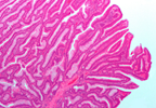 Long-term Antibiotic Use in Adulthood May Increase Colorectal Adenoma Risk Long-term Antibiotic Use in Adulthood May Increase Colorectal Adenoma Risk