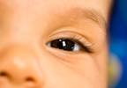 Ophthalmic Exam Recommended in Infants With Congenital Zika Syndrome Ophthalmic Exam Recommended in Infants With Congenital Zika Syndrome