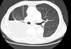 AATS: Guidelines for Empyema Management Released AATS: Guidelines for Empyema Management Released