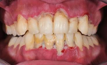 Periodontal Disease and Rheumatoid Arthritis: What Are the Links? Periodontal Disease and Rheumatoid Arthritis: What Are the Links?