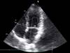 Predicting Cardiovascular Outcomes in Liver Transplant Candidates Predicting Cardiovascular Outcomes in Liver Transplant Candidates