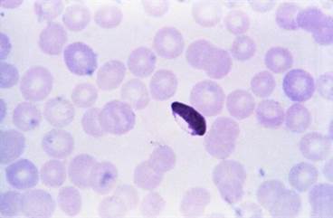 Placental Malaria and Risk of Malaria Infection in Childhood Placental Malaria and Risk of Malaria Infection in Childhood