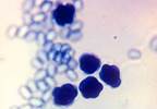 Amphotericin B Better Than Itraconazole in HIV-Linked Talaromycosis Amphotericin B Better Than Itraconazole in HIV-Linked Talaromycosis