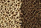 Early ART Initiation May Increase Bone Loss in Patients With HIV Early ART Initiation May Increase Bone Loss in Patients With HIV