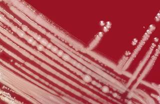 Of the 27 patients who completed the study, atorvastatin did not significantly improve cough, the primary end point. Of the 27 patients who completed the study, atorvastatin did not significantly improve cough, the primary end point.