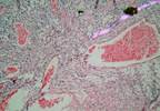 HIV Status May Not Effect Incidence of Invasive Cervical Cancer HIV Status May Not Effect Incidence of Invasive Cervical Cancer