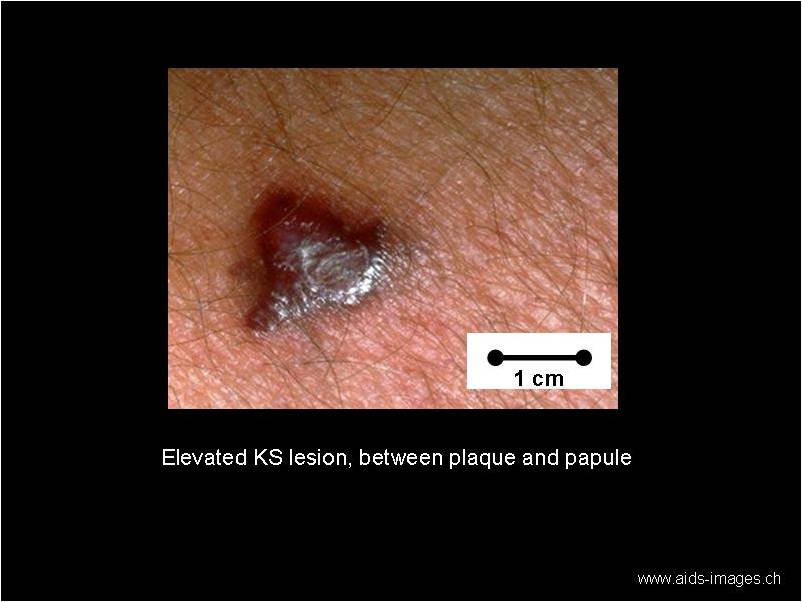 Kaposi (KS)(Clinical Condition)