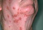 Pain and Itch Highly Prevalent in Patients With HZ Pain and Itch Highly Prevalent in Patients With HZ