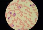 Antimalarial Activity Noted With KAF156 in Adults Antimalarial Activity Noted With KAF156 in Adults