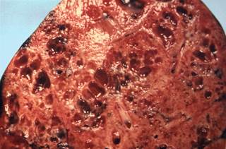 Lung tissue extracted from a patient with a fatal case of legionellosis, a disease caused by <i>L pneumophila.</i> <i>Photo Credit: CDC/ John A. Blackmon, MD</i> Lung tissue extracted from a patient with a fatal case of legionellosis, a disease caused by <i>L pneumophila.</i> <i>Photo Credit: CDC/ John A. Blackmon, MD</i>