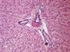 Anti-HBc Transfer Common in Intravenous Immunoglobulin Infusion Anti-HBc Transfer Common in Intravenous Immunoglobulin Infusion