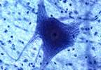 Antiretroviral Therapy Effective for Treatment of HIV-Related Motor Neuron Disease Antiretroviral Therapy Effective for Treatment of HIV-Related Motor Neuron Disease