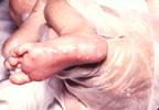 FDA Grants N-Methanocarbathymidine Orphan Drug Designation FDA Grants N-Methanocarbathymidine Orphan Drug Designation