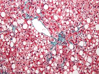 Body weight and waist circumference was reduced in participants who used both dapagliflozin with omega-3 carboxylic acids. Body weight and waist circumference was reduced in participants who used both dapagliflozin with omega-3 carboxylic acids.