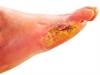 Efficacy of Antimicrobial Treatments In Diabetic Foot Ulcers Examined Efficacy of Antimicrobial Treatments In Diabetic Foot Ulcers Examined