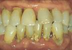 Periodontitis May Impact Risk For Dementia Periodontitis May Impact Risk For Dementia