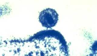 A case of HIV-1 infection despite emtricitabine-tenofovir disoproxil fumarate–based PrEP. <i>Photo Credit: National Institute of Allergy and Infectious Diseases (NIAID).</i> A case of HIV-1 infection despite emtricitabine-tenofovir disoproxil fumarate–based PrEP. <i>Photo Credit: National Institute of Allergy and Infectious Diseases (NIAID).</i>
