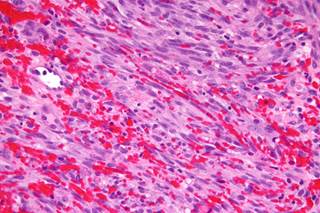 Children with HIV from sub-Saharan Africa living in Europe are at highest risk of Kaposi Sarcoma. <i>Photo Credit: By Nephron (Own work), via Wikimedia Commons</i> Children with HIV from sub-Saharan Africa living in Europe are at highest risk of Kaposi Sarcoma. <i>Photo Credit: By Nephron (Own work), via Wikimedia Commons</i>
