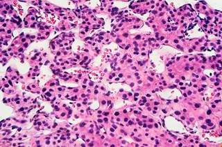 Fifty percent of patients achieved sustained viral response, which correlated with reduced incidence of hepatocellular carcinoma and hepatic decompensation. Fifty percent of patients achieved sustained viral response, which correlated with reduced incidence of hepatocellular carcinoma and hepatic decompensation.
