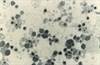 Case: Fever, Generalized Weakness One Year After Heart Transplant Case: Fever, Generalized Weakness One Year After Heart Transplant