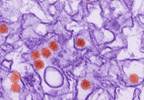 Exploring Links Between Zika, GBS, Microcephaly in Brazil Exploring Links Between Zika, GBS, Microcephaly in Brazil