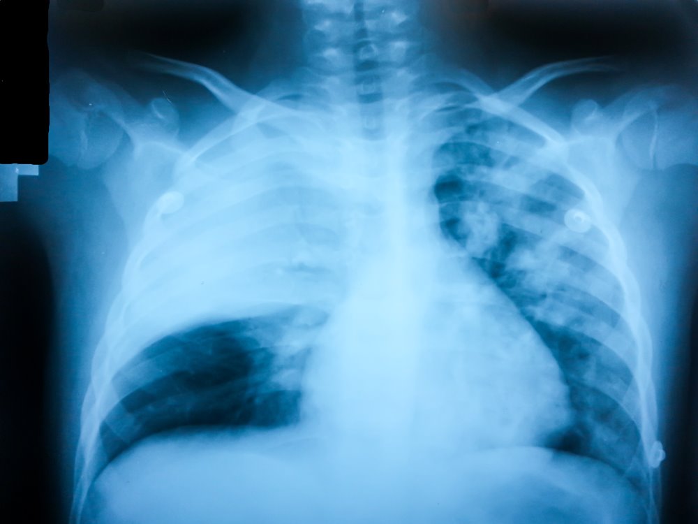 Lung Ultrasonography is Fast and Accurate for Diagnosing Pneumonia