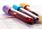 Tuberculosis Detection Could Improve With Conversion Value Change Tuberculosis Detection Could Improve With Conversion Value Change