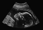 Sequelae of Congenital Cytomegalovirus Risk Limited to First Trimester Sequelae of Congenital Cytomegalovirus Risk Limited to First Trimester