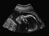 Approach to Reducing Vertical Transmission of HIV in Pregnancy Approach to Reducing Vertical Transmission of HIV in Pregnancy