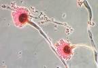 Aspergillosis, An Emerging Complication of Severe Flu Infections Aspergillosis, An Emerging Complication of Severe Flu Infections