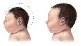 Severe microcephaly (left) vs typical head size. <i>Photo Credit: CDC via Wikimedia Commons.</i> Severe microcephaly (left) vs typical head size. <i>Photo Credit: CDC via Wikimedia Commons.</i>