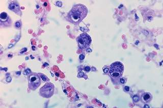 Letermovir is an investigational once-daily antiviral medicine under development for the prevention of CMV infection and disease. <i>Photo Credit: By Yale Rosen, via Wikimedia Commons.</i> Letermovir is an investigational once-daily antiviral medicine under development for the prevention of CMV infection and disease. <i>Photo Credit: By Yale Rosen, via Wikimedia Commons.</i>