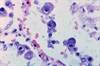 Ventriculomegaly, Polymicrogyria Predict Epilepsy Risk Among Pediatric Patients With CMV Infections Ventriculomegaly, Polymicrogyria Predict Epilepsy Risk Among Pediatric Patients With CMV Infections