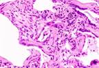 COPD Assessment Test Evaluates Interstitial Lung Disease COPD Assessment Test Evaluates Interstitial Lung Disease