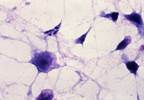 Bezlotoxumab May Reduce Recurrent C difficile Infections in High-Risk Groups Bezlotoxumab May Reduce Recurrent C difficile Infections in High-Risk Groups