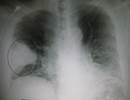 Accuracy of Lung Ultrasonography for Pneumonia Diagnosis Accuracy of Lung Ultrasonography for Pneumonia Diagnosis