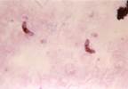 Antibody Therapy May Prevent Fatal Cerebral Malaria Antibody Therapy May Prevent Fatal Cerebral Malaria