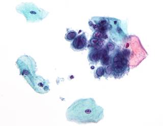 Micrograph showing the changes of herpes simplex virus. <i>Photo Credit: By Nephron via Wikimedia Commons</i> Micrograph showing the changes of herpes simplex virus. <i>Photo Credit: By Nephron via Wikimedia Commons</i>