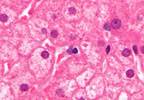 Elevated Risk of HBV Reactivation in Patients With RA Elevated Risk of HBV Reactivation in Patients With RA