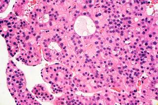 Hepatitis C virus attributing to hepatocellular carcinoma in high-income countries is growing. Hepatitis C virus attributing to hepatocellular carcinoma in high-income countries is growing.