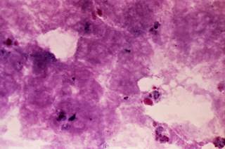 A Giemsa stain of a blood film from an infected human identifying <i>Babesia microti</i>. <i>Photo Credit: CDC/Dr. George Healy</i> A Giemsa stain of a blood film from an infected human identifying <i>Babesia microti</i>. <i>Photo Credit: CDC/Dr. George Healy</i>