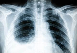 Rosuvastatin may improve symptoms of COPD in HIV-infected individuals with abnormal lung function. Rosuvastatin may improve symptoms of COPD in HIV-infected individuals with abnormal lung function.